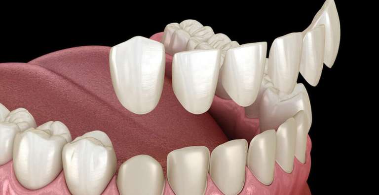 dental veneers min