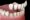 veneers min